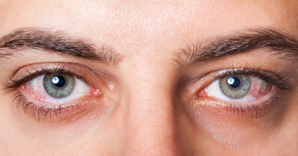 Dry Eyes Solution
